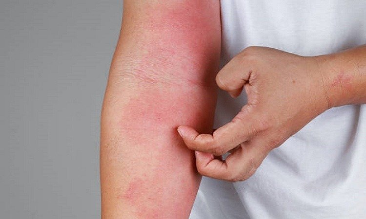 Situata me viruset është qetësuar  por janë shtuar kontrollet për alergji sezonale