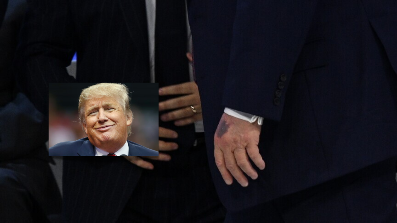 Mjeku i Trumpit pretendon se mavijosjet në duart e presidentit janë shkaktuar nga  shtrëngimet e shpeshta të duarve 